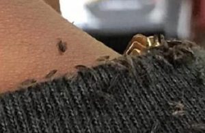 Man goes viral for extreme head lice infestation